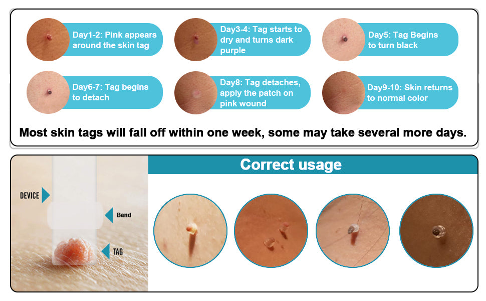 ULK-S01 3 IN 1 Auto Skin Tag Remover Kit