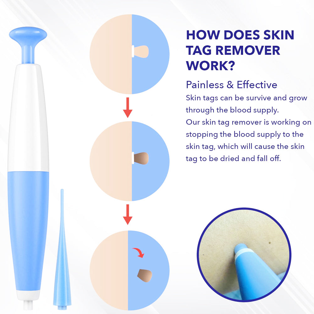 ULK-S02 Painless Mole Wart Remover Skin Tag Removal Kit