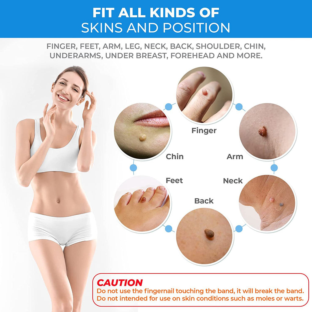 ULK-S07 Blue Set Skin Tag Remover Kit Skin Tag Removal Mole Stain Wart Removers