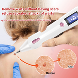 ULK-S11 LCD Laser Mole Removal Pen Wart Plasma Remover Tool