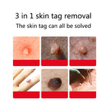 ULK-S01 3 IN 1 Auto Skin Tag Remover Kit