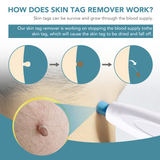 ULK-S01 3 IN 1 Auto Skin Tag Remover Kit