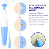 ULK-S02 Painless Mole Wart Remover Skin Tag Removal Kit