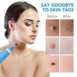 ULK-S03 2 In 1 Skin Tag Removers Kit